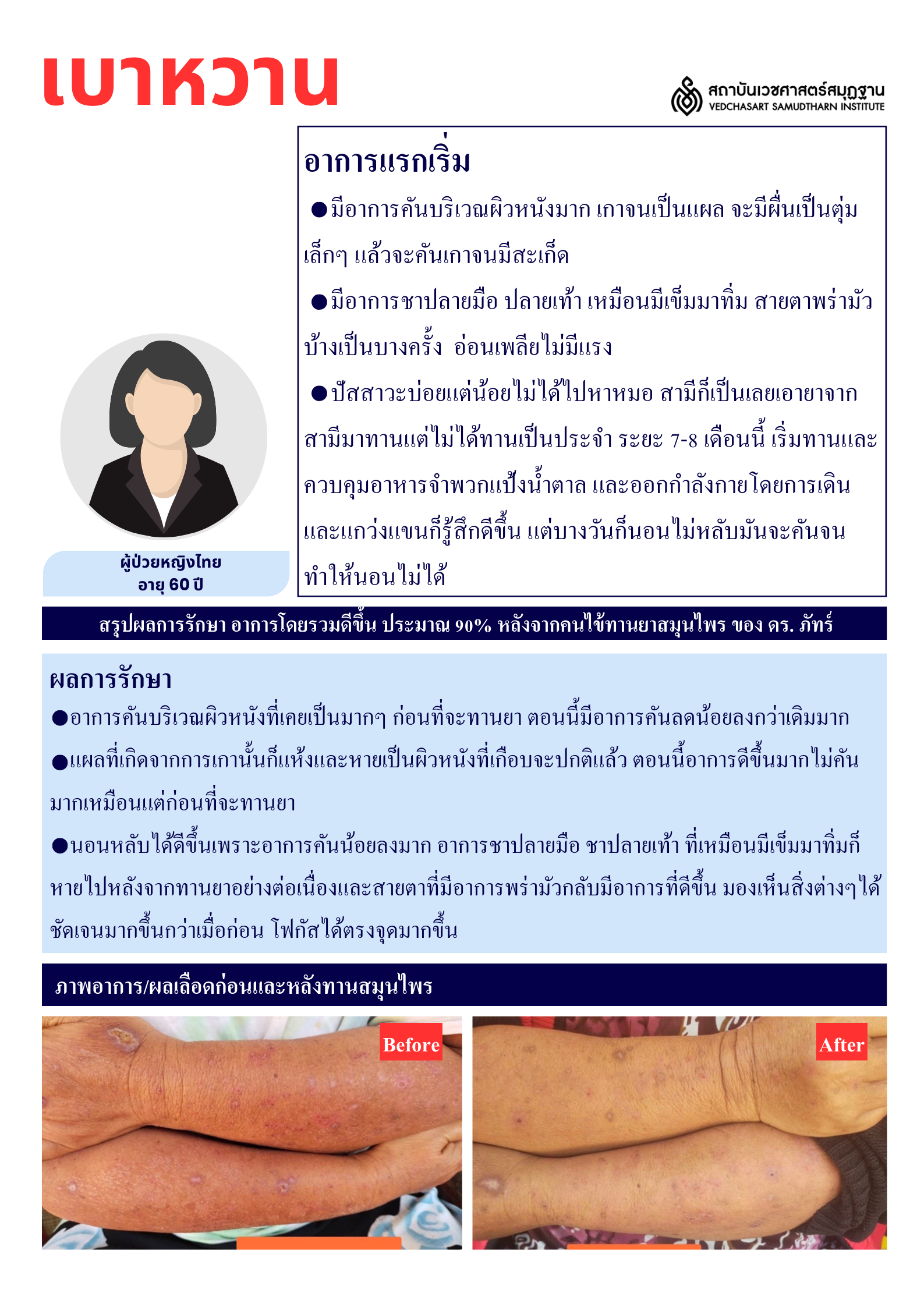 โรคเบาหวาน Diabetes