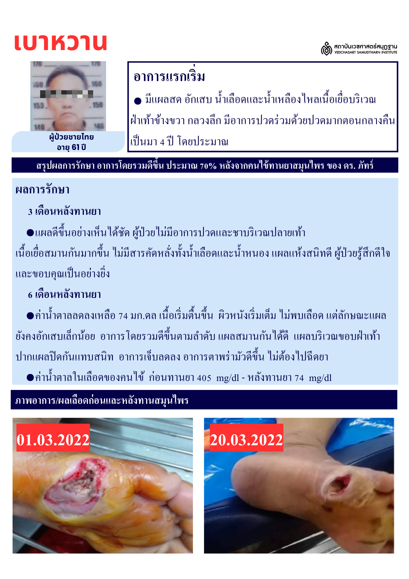 โรคเบาหวาน Diabetes