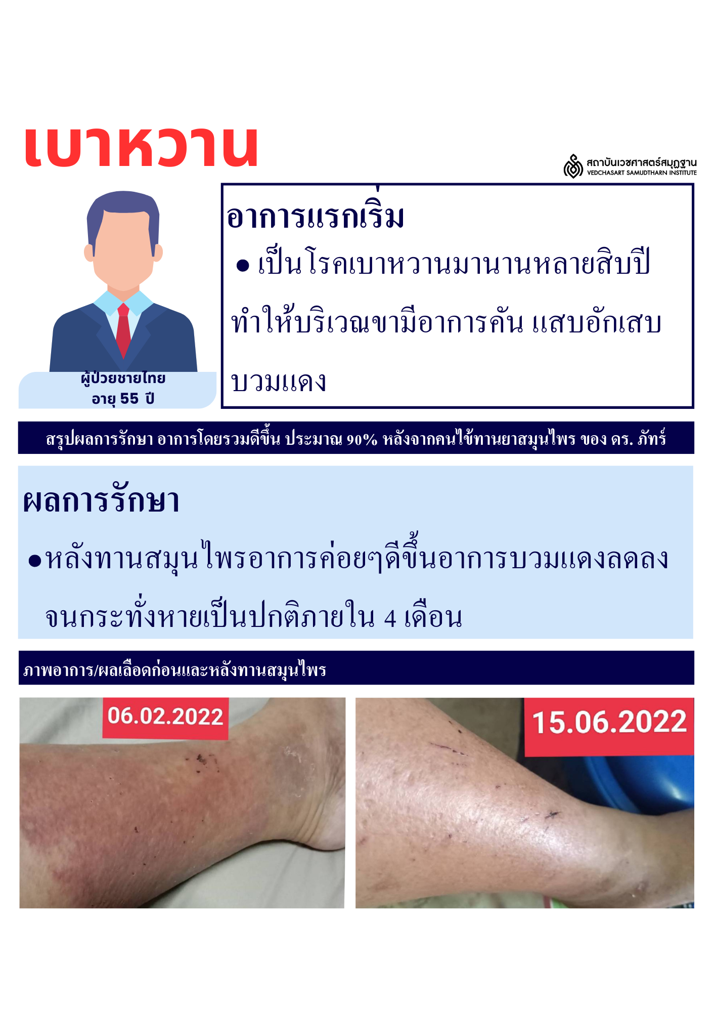 โรคเบาหวาน Diabetes